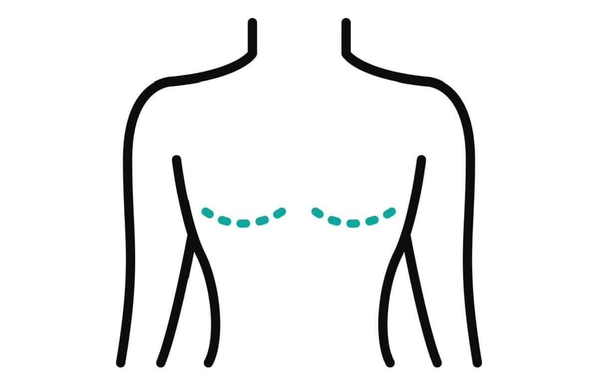 buyer beware mastectomy