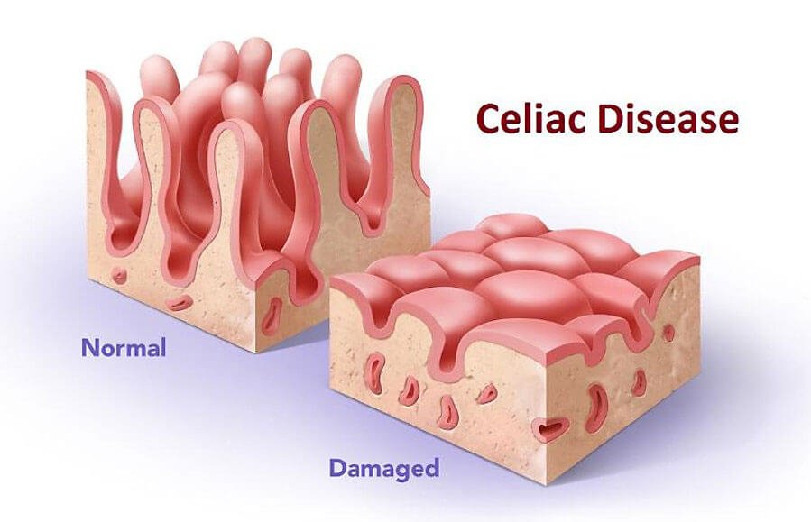 resources information celiac
